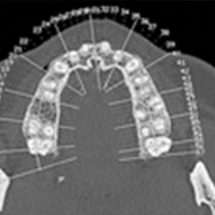 bilan osseux résoscan
