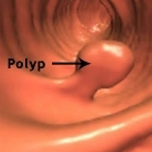 Coloscopie virtuelle résoscan