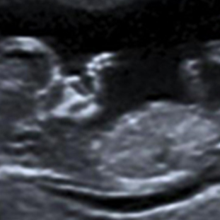 échographie et doppler résoscan