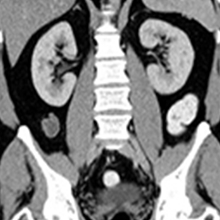 Scanner tomodensitometrie-axiale résoscan