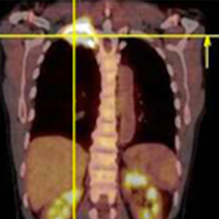 Tomographie par émission de positrons RésoScan